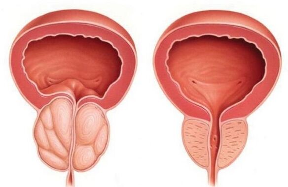 prostata normale e ingrossata con prostatite