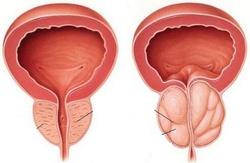 una prostata sana e infiammata con prostatite cronica